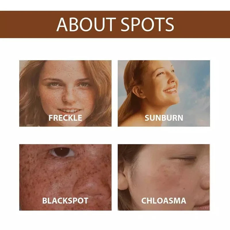 Brightening 30ml Anti Freckle Serum