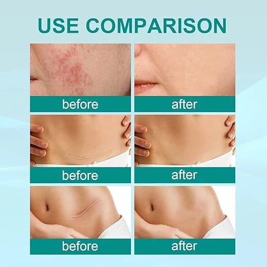 South Moon Scar Care Spray Treatment
